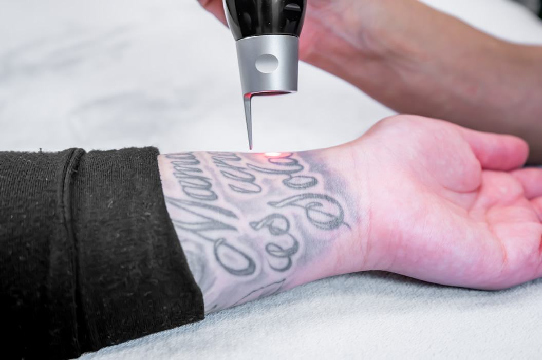 Tattoo behandling
