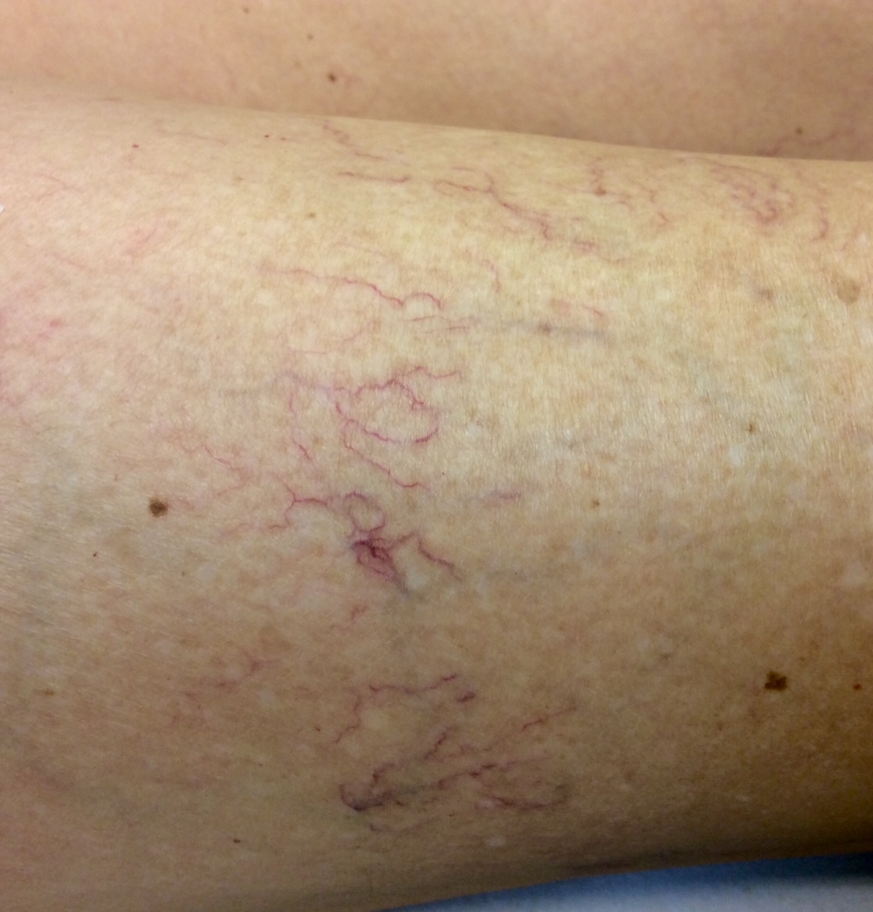Sclerosering Hudklinikken Sclerosering Hudklinikken