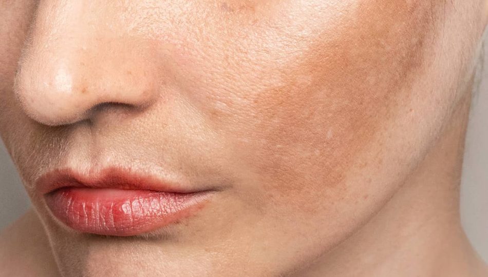 En kvinne med hormonelle pigmentflekker på kinnet