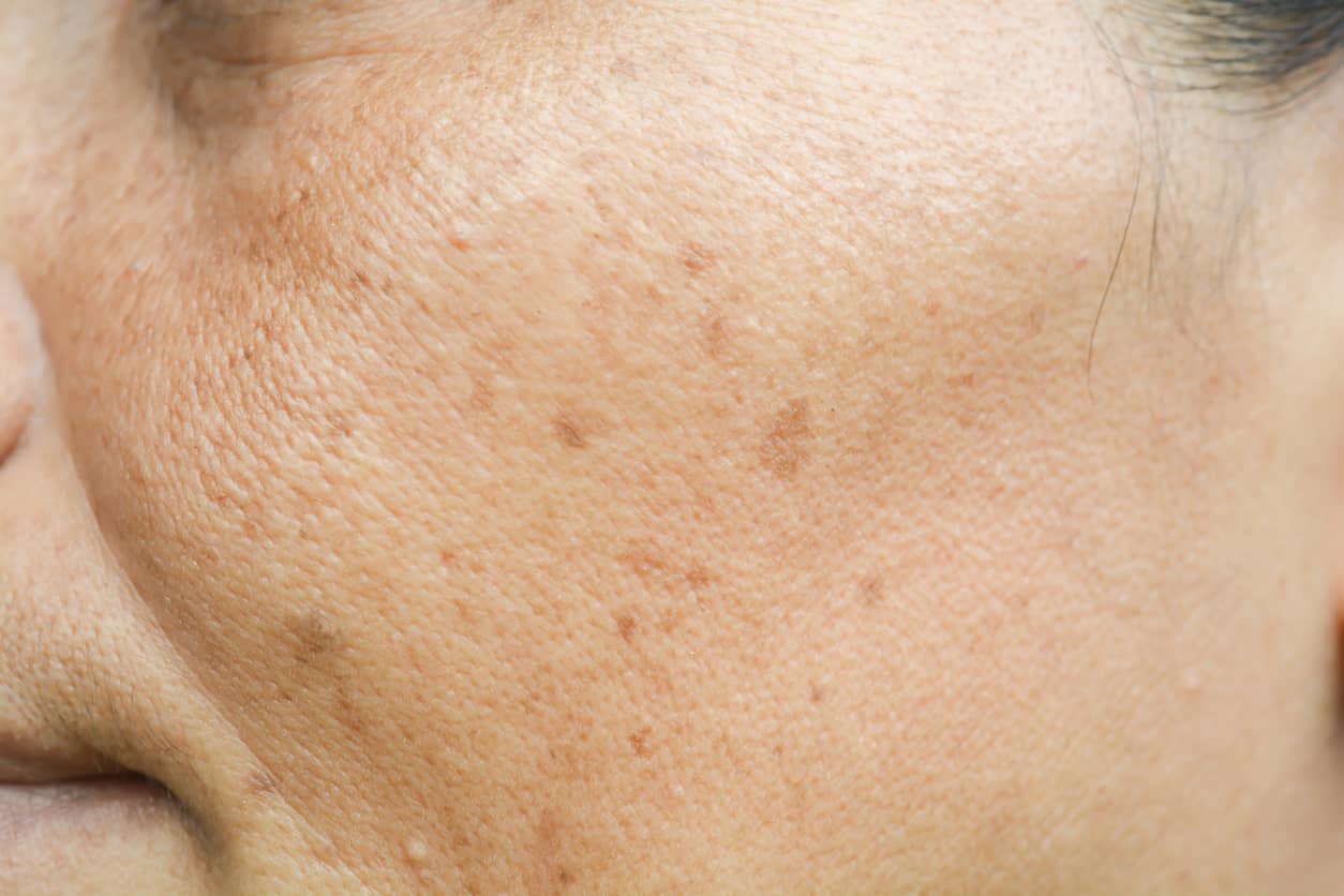 En kvinne med pigmentflekker i ansiktet.