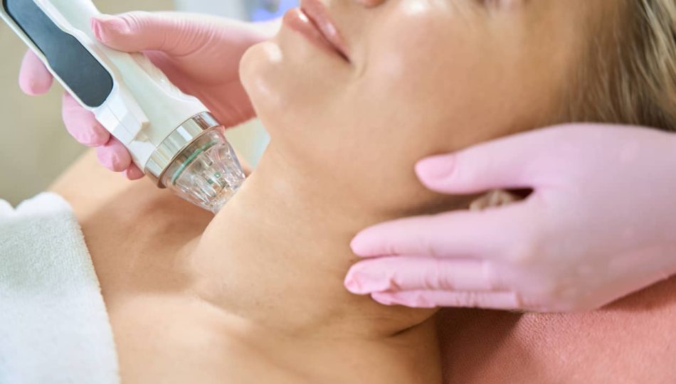 Kvinne som får utført RF microneedling-behandling.