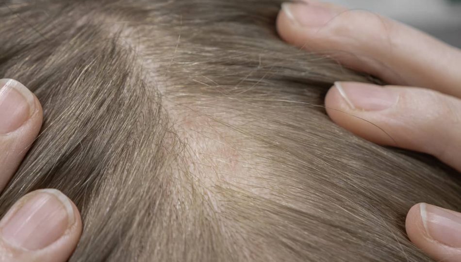 Nærbilde av hodebunn med et avgrenset område med flekkvis hårtap
